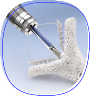 mitraclip